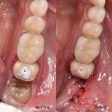 Picture of Odontectomy - Tooth Removal