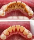 Picture of Oral Prophylaxis (Teeth Cleaning)