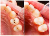 Picture of Tooth Filling