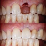 Picture of Tooth Implant